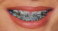 BRACES - US - Info - Page : http://www.bracesinfo.com/braces/index.html